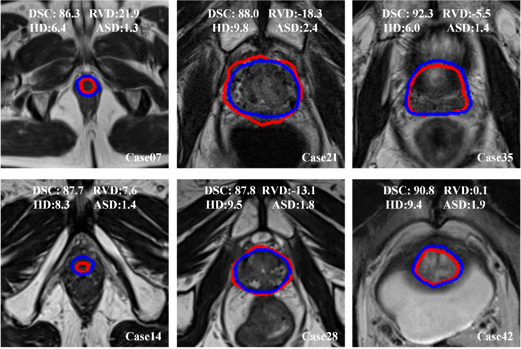 multiparametric mri prostate)